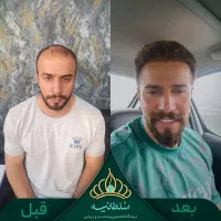 کاشت مو پر تراکم با طراحی خط رویش مو