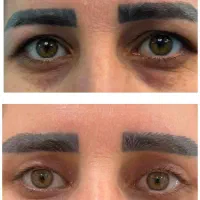 بلفارو پلاستی