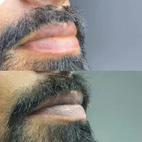 فیبروزابروی آقایان ورفع کبودی لب اقایان اقساط4ماهه