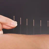 طب سوزنی و آموزش طب سوزنی