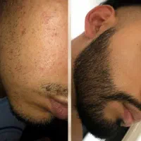 کمتر از ۳۰ روز رویش دوباره مو و ریش بصورت دائمی