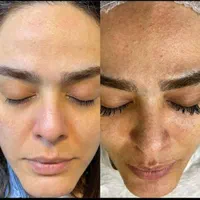 ریمو تتو.کربن ترابی صورت.روشن‌کردن نواحی تیره|خدمات آرایشگری و زیبایی|قم, باجک دو|دیوار