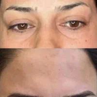 مدل میکروبلیدینگ رایگان در سعادت اباد