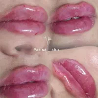 ژل، فیلر لب 600،آنزیم ۵۰۰،بوتاکس۶۰۰