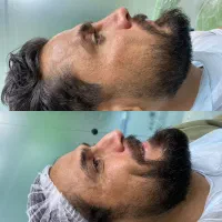 جشنواره فیلر ژل لب بوتاکس لیفت بانخ پی ار پی مزوژل|خدمات زیبایی و سلامت|تهران, کیانشهر|دیوار