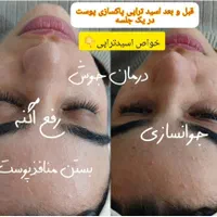 پاکسازی و فیشال تخصصی و درمانی با بهترین برندها|خدمات آرایشگری و زیبایی|پرند, فاز ۲|دیوار