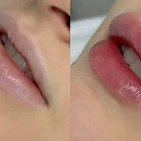 اموزش ژل و بوتاکس به صورت اصولی و حرفه ای