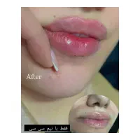تزریقات تخصصی ژل و بوتاکس|خدمات آرایشگری و زیبایی|اهواز, شهرک دانشگاه|دیوار