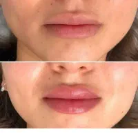 مدل ژل لب بوتاکس