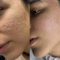 با پوست پر جوش و پر از لک خدافظی کن