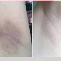 وایتکس رفع تیرگی های بدن
