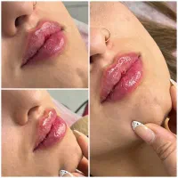 بوتاکس،فیلر توسط پزشک پوست و زیبایی(تخفیف استثنایی|خدمات آرایشگری و زیبایی|تهران, دروس|دیوار