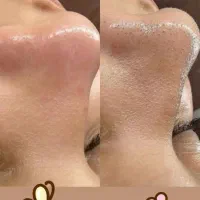 فیشال وپاکسازی.درما.پلاژن .کربوکسی.اسید تراپی|خدمات آرایشگری و زیبایی|مشهد, کوی سیدی|دیوار