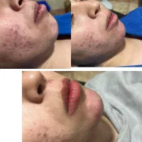 ژل بوتاکس|خدمات آرایشگری و زیبایی|دورود, |دیوار