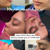 آف زیبایی لیپو ابدو عمل بینی ۱۹ میلیون|خدمات آرایشگری و زیبایی|خرمشهر, |دیوار