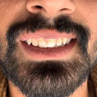 کامپوزیت 20تومن|خدمات آرایشگری و زیبایی|دورود, |دیوار