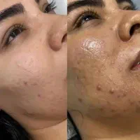 آموزش فشیال و درمان پوست (تخصصی پزشکی)|خدمات آموزشی|اردبیل, |دیوار