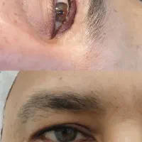 بلفاروپلاستی پلک بالا به مدت محدود فقط 8 میلیون|خدمات آرایشگری و زیبایی|بوکان, |دیوار