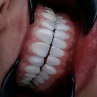 عصب کشی و پر کردن با پایین ترین قیمت در شهرک واوان