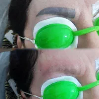 پاک کردن تتو و خالکوبی با دستگاه لیزر کیوسوئیچ