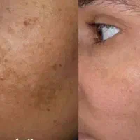 صورتی صاف داشته باش ( بیوممتیک همه کاره) درب منزل