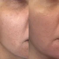 مدل برای تکمیل آلبوم لاین تخصصی پوست|خدمات زیبایی و سلامت|کرج, مهرویلا جنوبی|دیوار