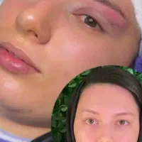 جشنواره بلفاروپلاسی چشم گربه ای سانترال لب