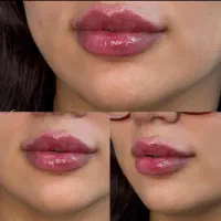 ژل و بوتاکس