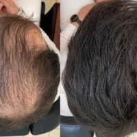 از جمع کچلا در بیا