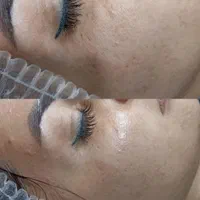 فشیال پوست رفع لک در مطب زیبایی .بانوان -اقایان|خدمات آرایشگری و زیبایی|شیراز, رازی|دیوار