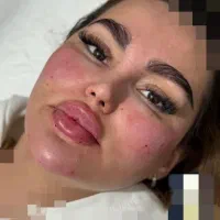 تزریق ژل لب .چانه.کات گونه.خط خنده