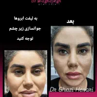 لیزر تزریق بوتاکس ژل فیلر مزوتراپی هایفو توسط پزشک|خدمات آرایشگری و زیبایی|پرند, فاز ۲|دیوار