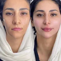 لیفت و جوانسازی صورت با ارزان ترین قیمت توسط پزشک|خدمات آرایشگری و زیبایی|مشهد, هنرستان|دیوار
