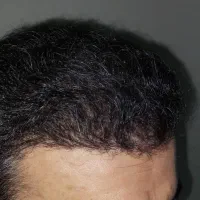 کاشت مو و ابرو با جدید ترین دستگاه های روز دنیا