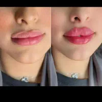 جشنواره تخفیف بوتاکس|خدمات آرایشگری و زیبایی|قم, صفاشهر|دیوار