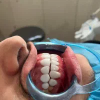 کامپوزیت دندان و عصبکشی دندان و بیلیچینگ وجرمگیری