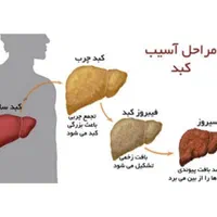 کبد چرب|آرایشی، بهداشتی، درمانی|اردبیل, |دیوار