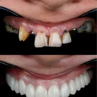 ایمپلنت فوری فقط۱۰۳۰۰/دندانپزشکی با اقساط۶-۱۵ماهه