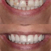 کامپوزیت دندان