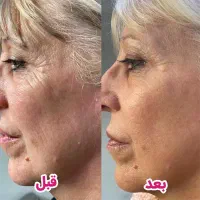 مزوژل درکلینیک زیبایی