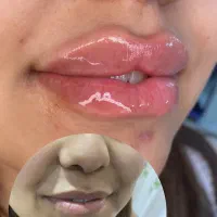 ژل و بوتاکس|خدمات آرایشگری و زیبایی|شوشتر, |دیوار