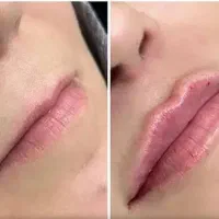 تخفیف ۴۰ درصدی تزریق بوتاکس، فیلر و مزوتراپی