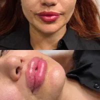 تزریق ژل لب و بوتاکس نچرال ،فیلر و جوانسازی