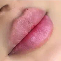 مدل فیلر لب فقط با هزینه مواد