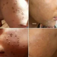 بهبودی ززگیل و تبخاال تظمینی|آرایشی، بهداشتی، درمانی|آبادان, |دیوار