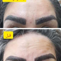 تخفیف بوتاکس، ژل، مزوژل، پی آر پی توسط پزشک|خدمات آرایشگری و زیبایی|مشهد, گوهرشاد|دیوار