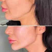 کانتورینگ صورت/ رفع غبغب/لیفت پوست/لیفت شقیقه