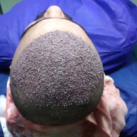 کاشت موی طبیعی|خدمات آرایشگری و زیبایی|شیراز, قدوسی شرقی|دیوار