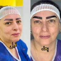 کاشت مو اقساطی باضمانت نامه کتبی مادام‌العمر|خدمات آرایشگری و زیبایی|یزد, |دیوار