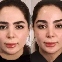 بوتاکس صورت